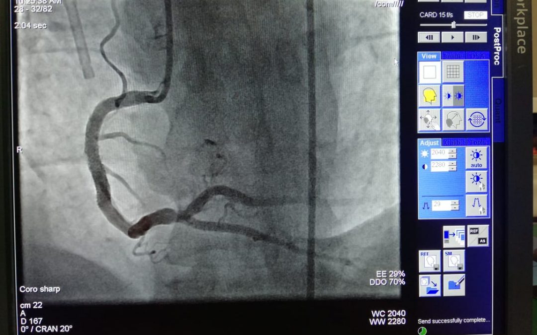 Another Shockwave case performed successfully in KSA