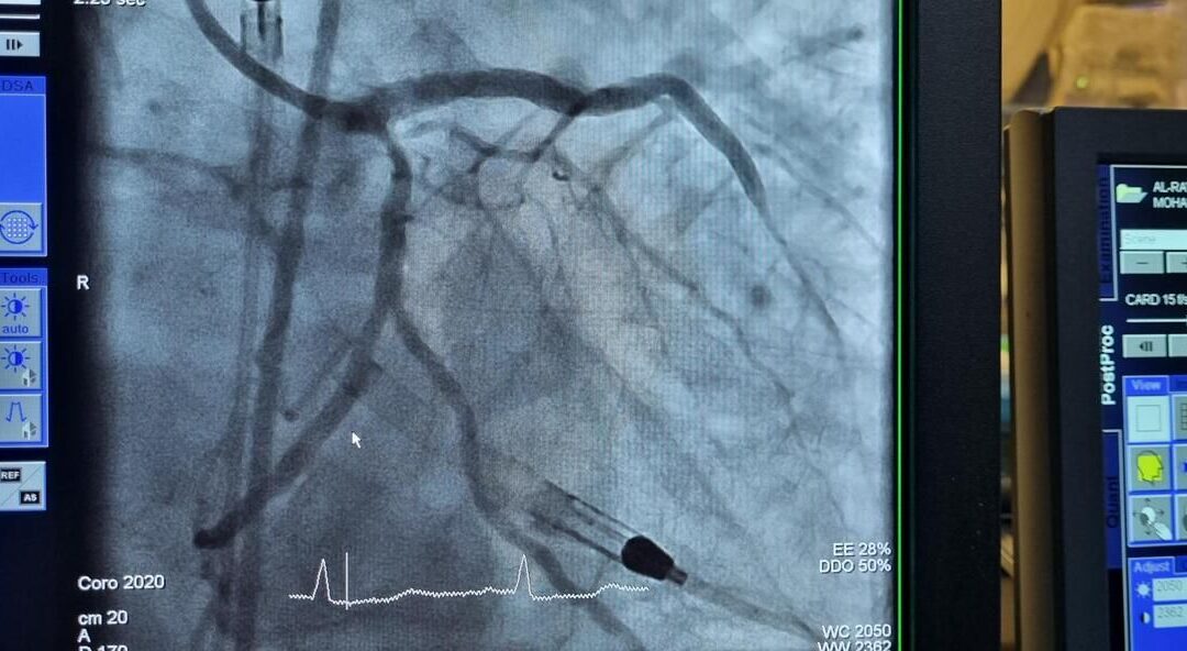 Successful High-Risk PCI in Complex STEMI Case using Impella® CP